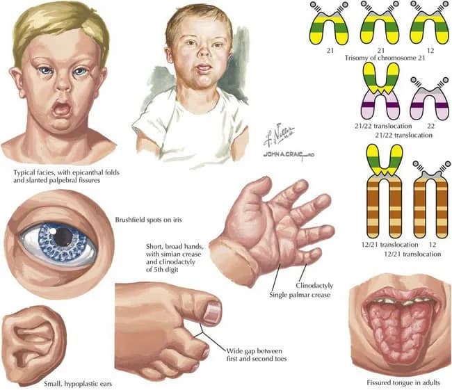 Medical illustration of the physical characteristics of Down syndrome and the chromosome 21 patterns that cause it